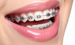 Diş Teli Fiyatları Ne Kadar?