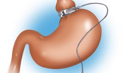 Fazla Kilolarla Mücadelede Cerrahi Bir Seçenek: Tüp Mide Ameliyatı