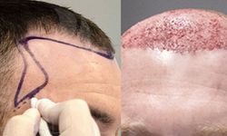 En İyi 10 Saç Ekimi Merkezi