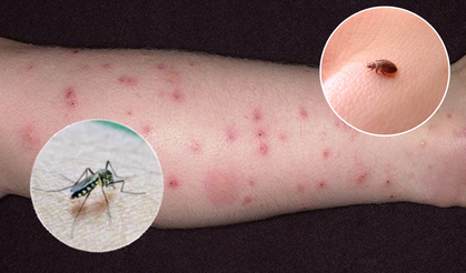 Sivrisinek ve pire kaynaklı öldürücü parazit vakalarında artış: Uzmanlar uyarıyor