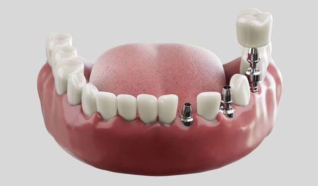 Diş İmplantı ve Diş İmplantı Fiyatları: Kalıcı Gülüşler İçin Modern Çözüm