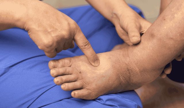 Dizde Ödem ve Şişlik Sorunlarında Erken Müdahale Büyük Önem Taşıyor!