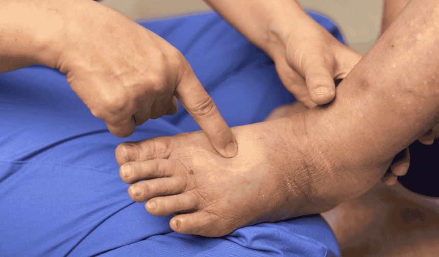 Dizde Ödem ve Şişlik Sorunlarında Erken Müdahale Büyük Önem Taşıyor!