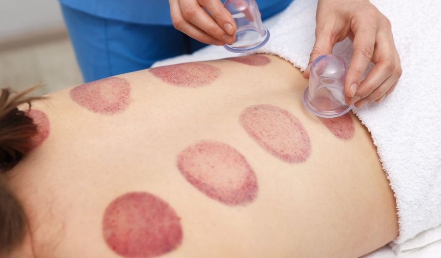 Hacamat Nedir? Faydaları Nelerdir ve Nasıl Yapılır?