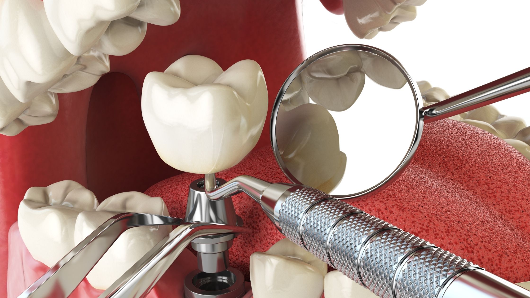 Implant Yerleştirmesi